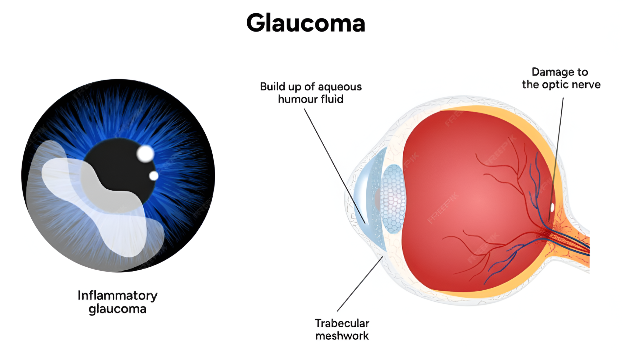 Can Glaucoma Cause Permanent Blindness? Everything You Need to Know ...