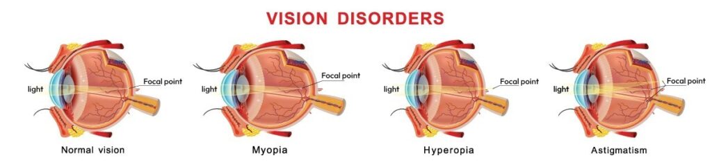 Myopia in Children: Causes, Symptoms & Latest Treatments | D.K. Eye Care Hospital